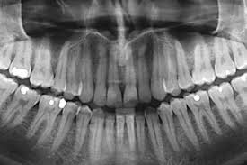 How safe to get Dental X-ray?